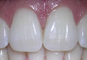 Homemade Whitening Big Teeth (hydrogen peroxide is the best of any of our Home Remedies for Whiter Teeth)
