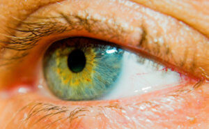 Rusty Iris (Does Oil Pulling Improve Vision? Maybe, maybe not)