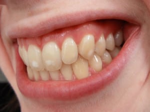Dental fluorosis
