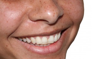Close Up Smile Could be Teeth Veneers