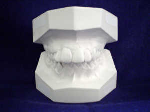 Teeth Mold Used to Prepare Teeth Veneers