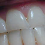 Remineralizing Toothpaste