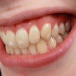 White Spots on Teeth?